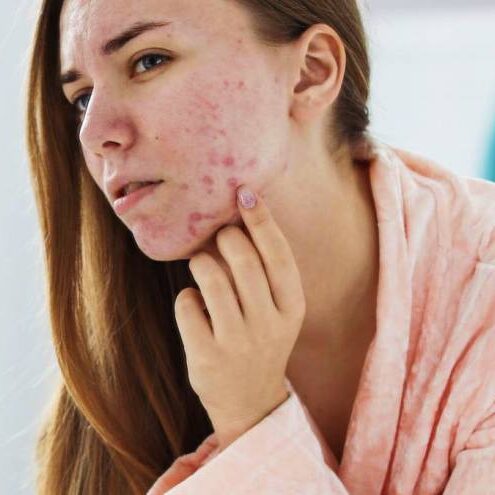 HOW TO CLEAR SEVERE ACNE?