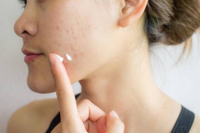 WHAT PRODUCTS DO YOU USE TO TREAT ACNE?