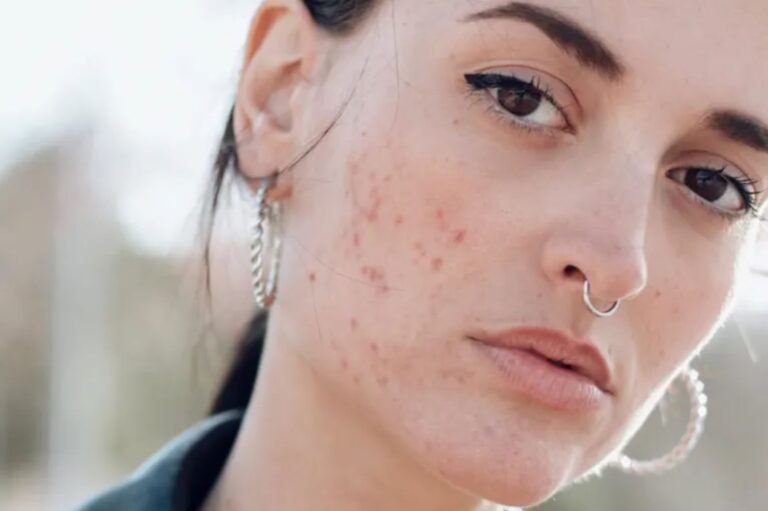 THINGS TO KNOW ABOUT ACNE AND ACNE SCARS