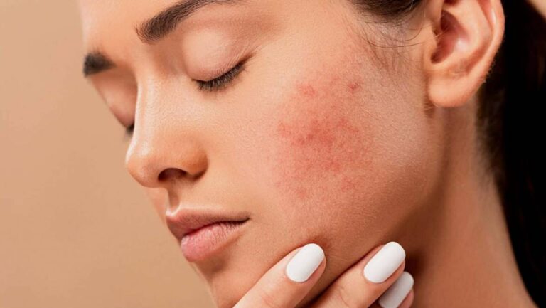 IDENTIFY DIFFERENT TYPES OF ACNE